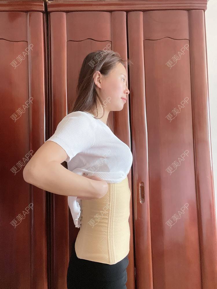 腰腹吸脂效果图_悦悦酱sama腰腹吸脂效果图_术后71天__更美