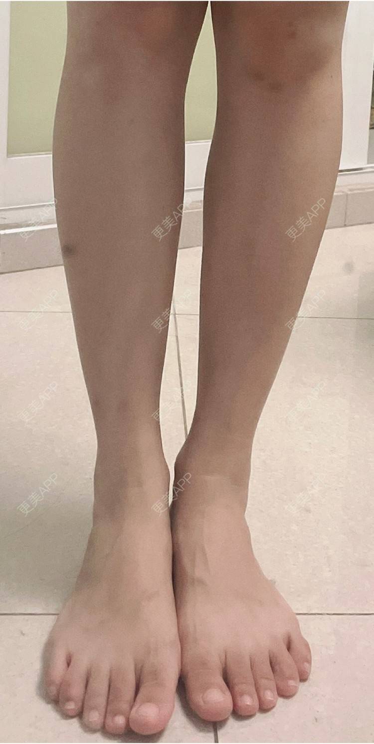 更美用户6vhxwhurnd的除皱瘦脸瘦腿日记
