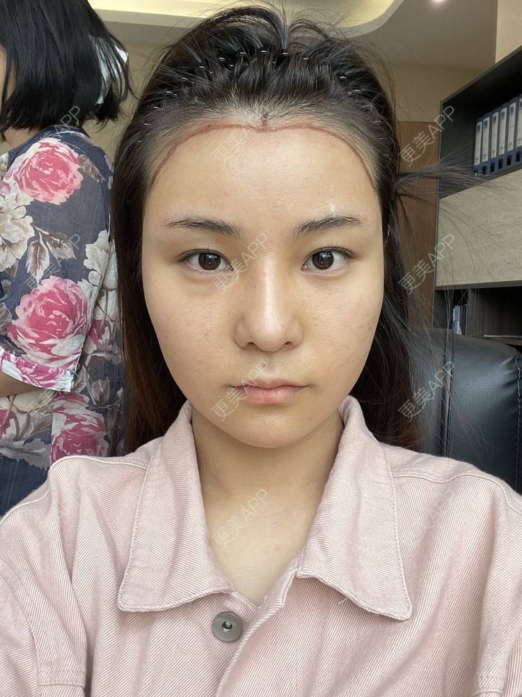 更美 - 喜宝i的植发际线经验 | 植发际线 | 头顶加密种植 | 美人尖植发 | 南昌