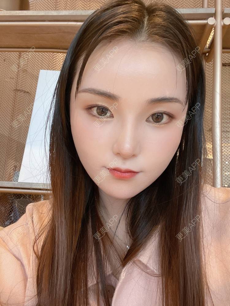 更美 - 喜宝i的植发际线经验 | 植发际线 | 头顶加密种植 | 美人尖植发 | 南昌