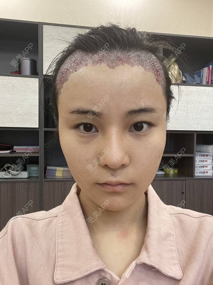 更美 - 喜宝i的植发际线经验 | 植发际线 | 头顶加密种植 | 美人尖植发 | 南昌