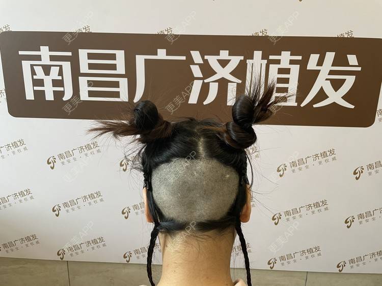 更美 - 喜宝i的植发际线经验 | 植发际线 | 头顶加密种植 | 美人尖植发 | 南昌