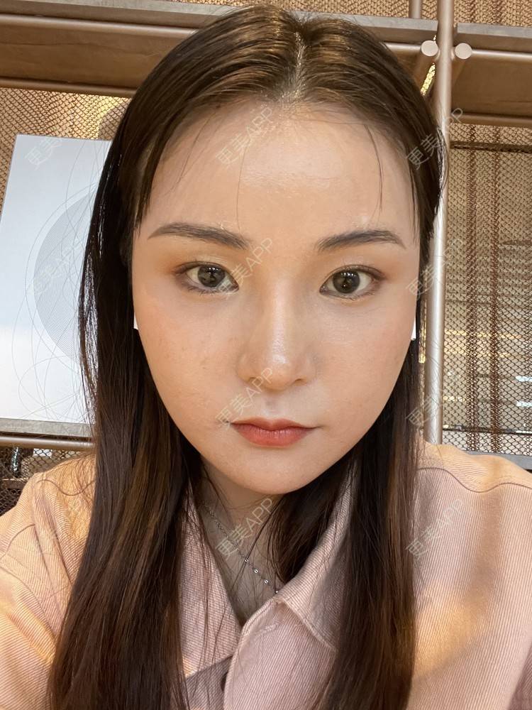 更美 - 喜宝i的植发际线经验 | 植发际线 | 头顶加密种植 | 美人尖植发 | 南昌