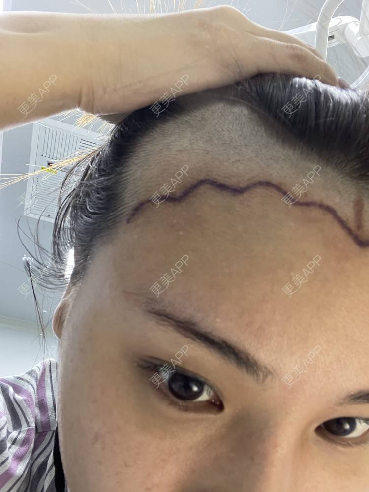 更美 - 喜宝i的植发际线经验 | 植发际线 | 头顶加密种植 | 美人尖植发 | 南昌