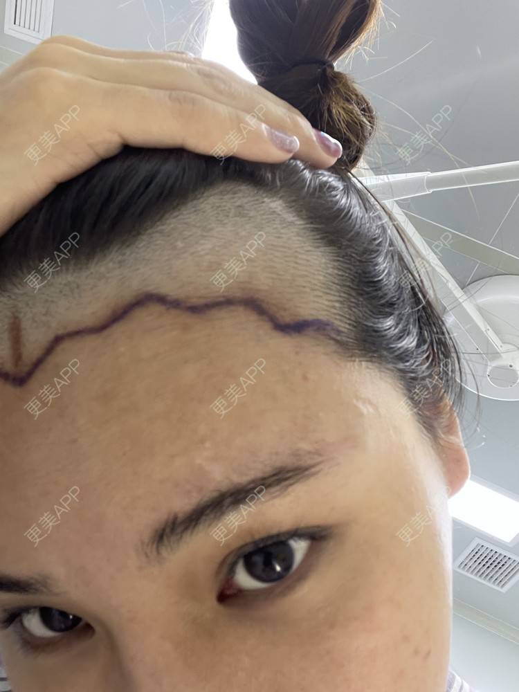 更美 喜宝i的植发际线日记 植发际线 头顶加密种植 美人尖