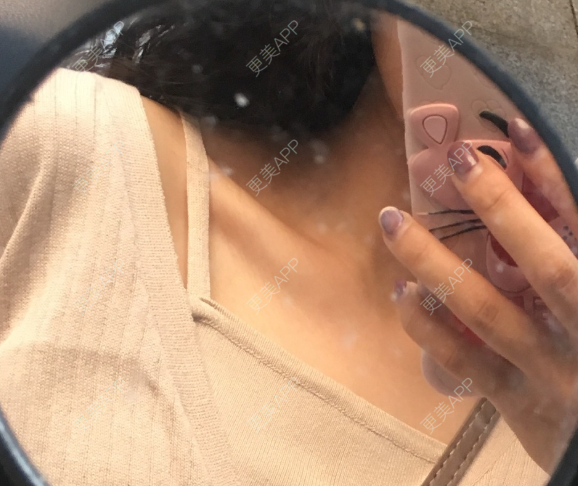 乳晕漂染前后对比照_更美用户cysd2ycoyk乳晕漂染前后对比照_术后90天