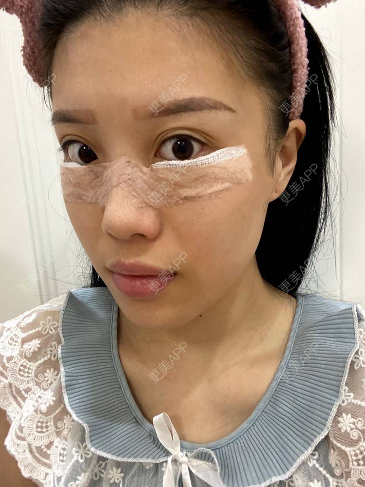 更美用户czif1j57wc的内切去眼袋日记