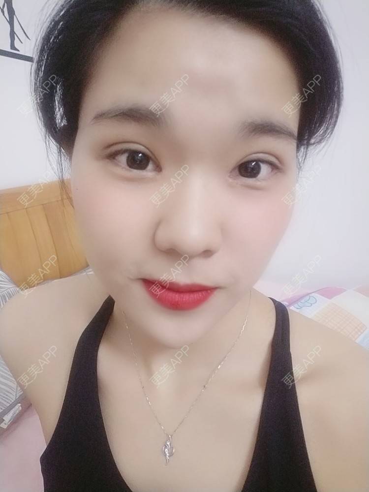 小小红花的全切双眼皮日记