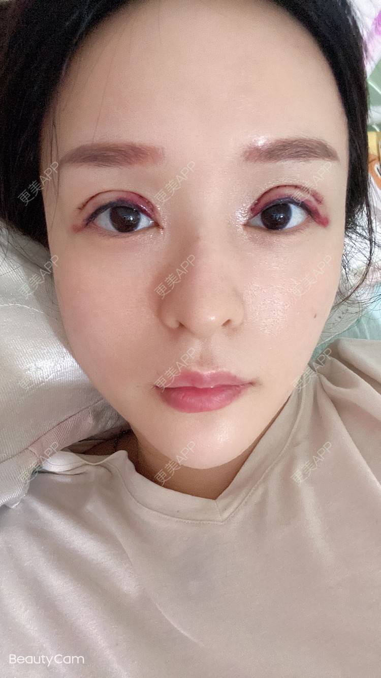 更美用户brxsxd8okm的全切双眼皮日记