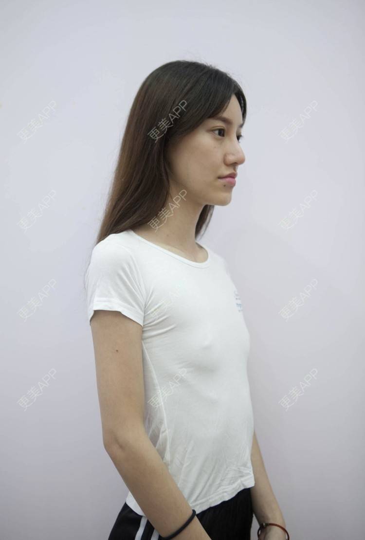 更美 - 夏芷希的全切双眼皮日记 | 假体隆胸 | 胸部下垂矫正 | 美胸