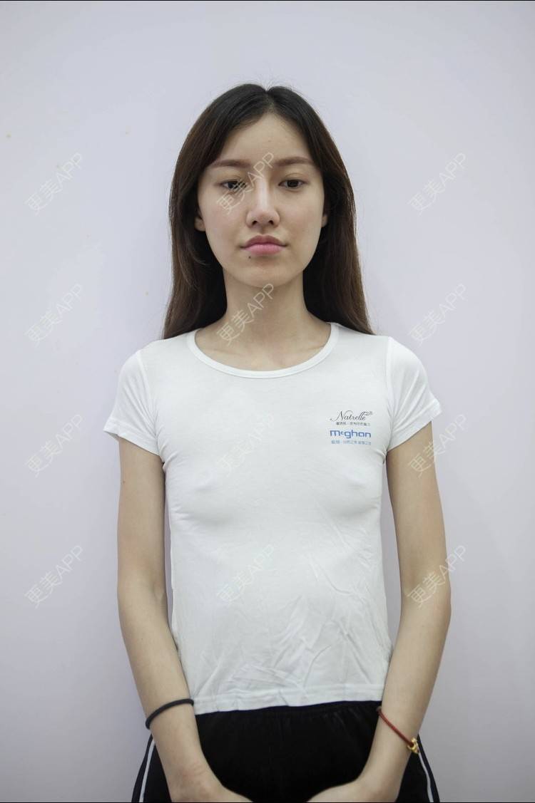 夏芷希的全切双眼皮日记