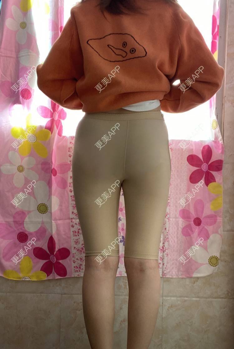 更美用户wxhvixqxsk的大小腿吸脂日记