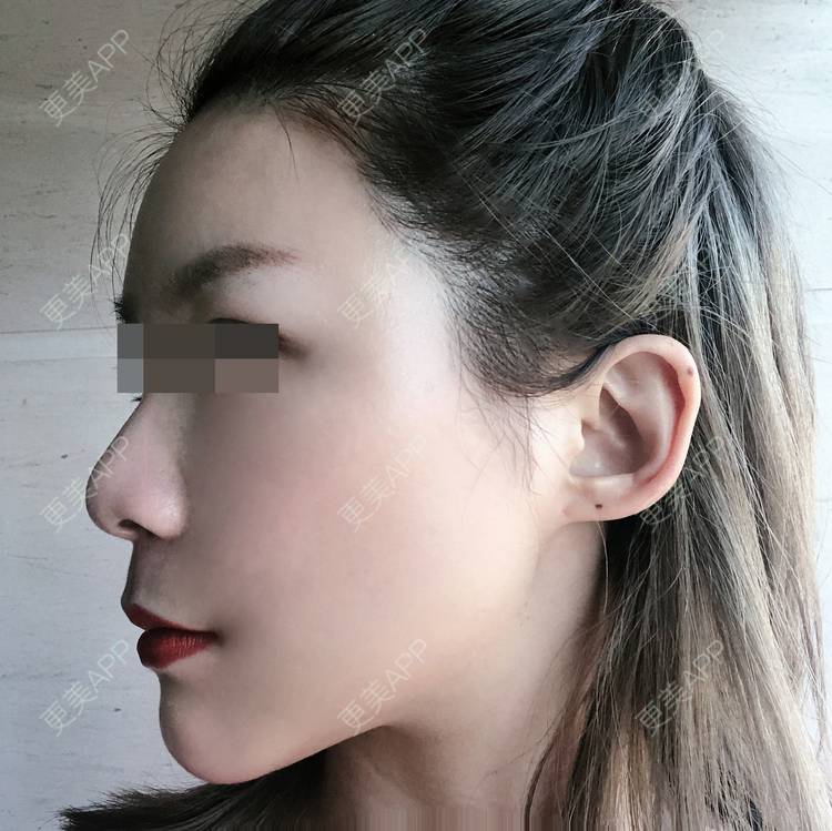 更美 - 饕餮少女静静的下颌缘吸脂日记 | 自体脂肪面部填充 | 吸脂