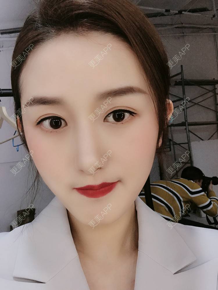 隆鼻,隆鼻效果图_更美用户arngsbwcej隆鼻效果图_术后376天__更美