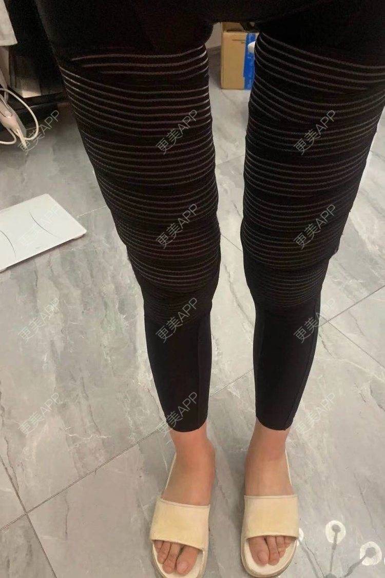 吸脂瘦大腿前后对比照_更美用户q7lnmiah1r吸脂瘦大腿前后对比照_术后