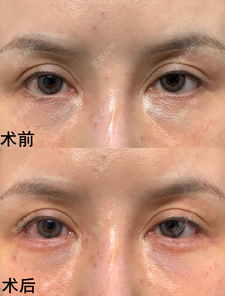 玻尿酸卧蚕手术_更美用户blnstwbxyg玻尿酸卧蚕手术_术后7天__更美