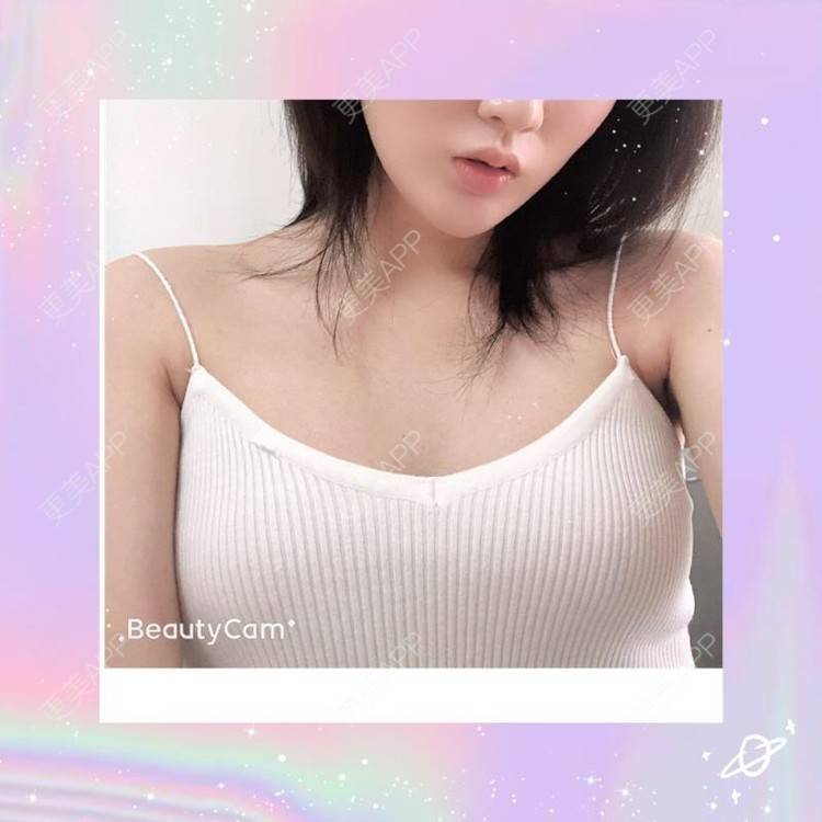 丰胸(隆胸)日记 | 丰胸(隆胸) | 假体隆胸 | 胸部下垂矫正 | 美胸套餐