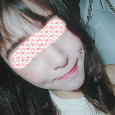 双侧埋线酒窝术后6天,两边消肿了很多,听医生说完全消肿要一个月的