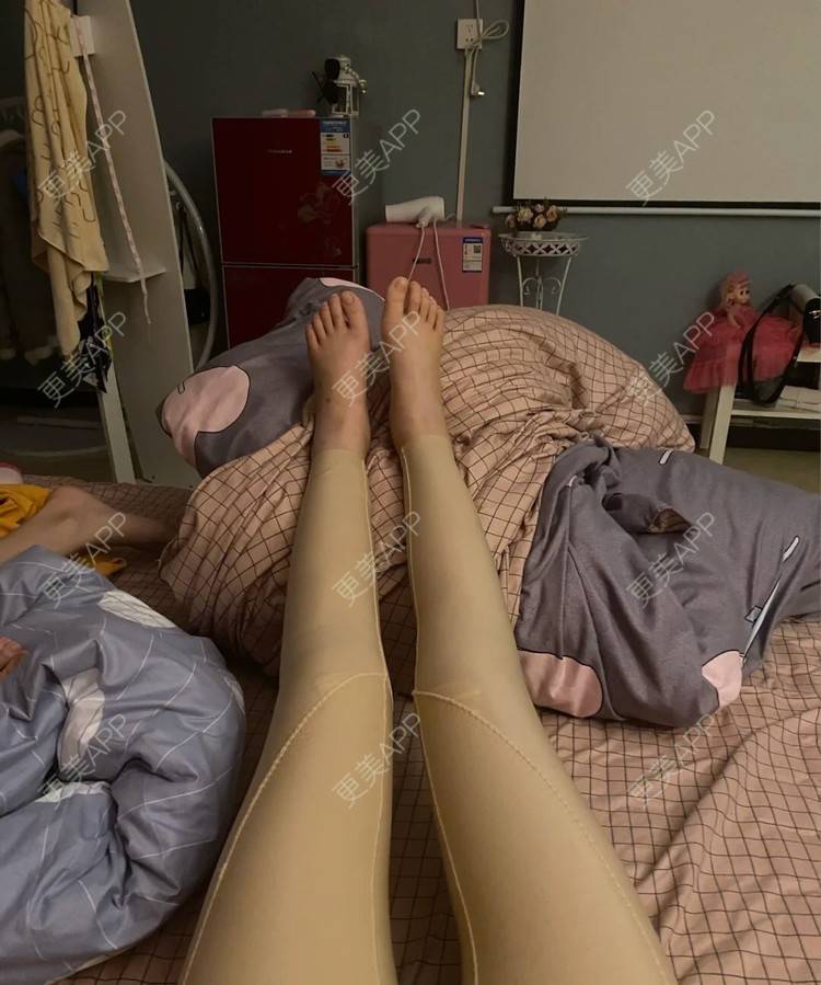 更美用户n7qdnvlzlk的吸脂瘦大腿日记