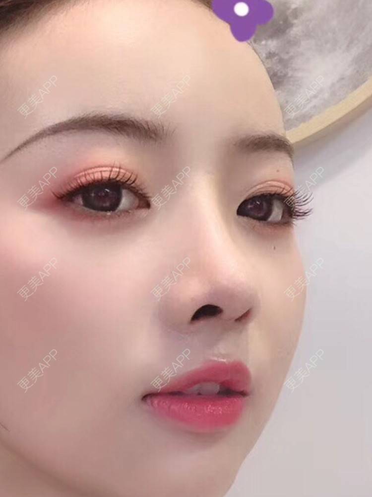 更美用户g59ubb3a0m的肋软骨隆鼻日记