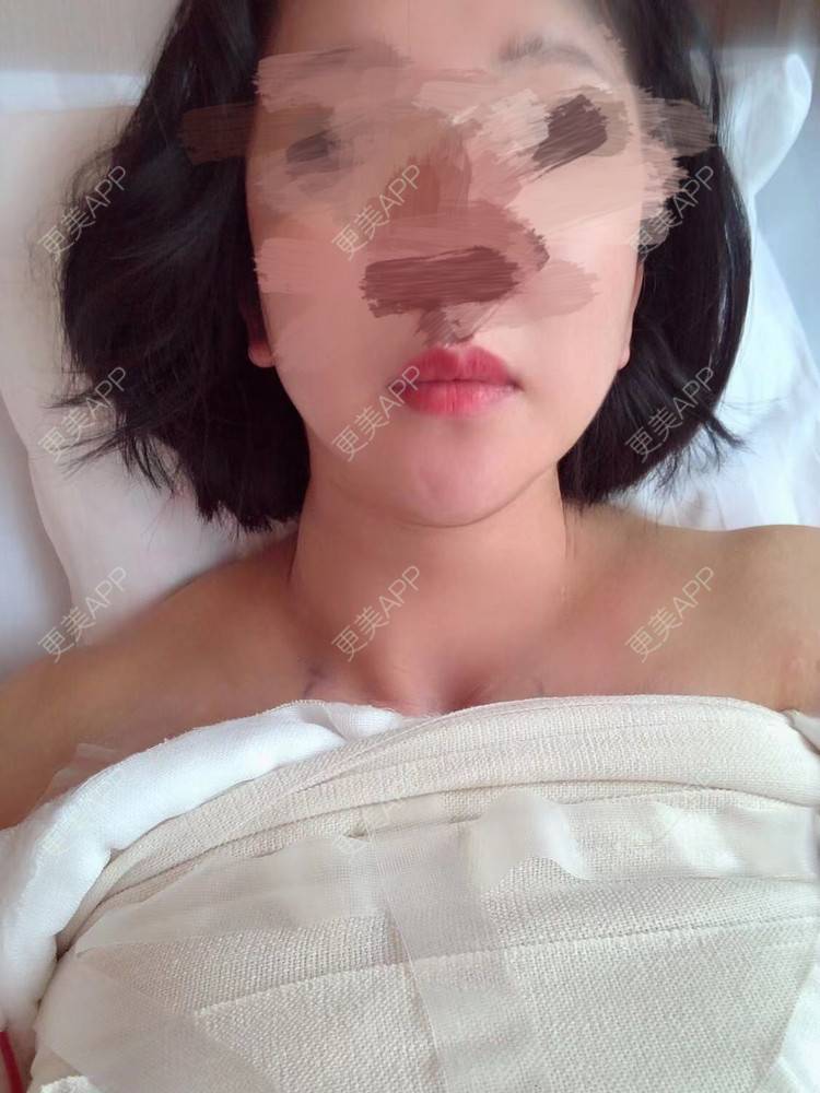 胸部下垂矫正手术_更美用户m1f06ovcym_术后115天__更美整形