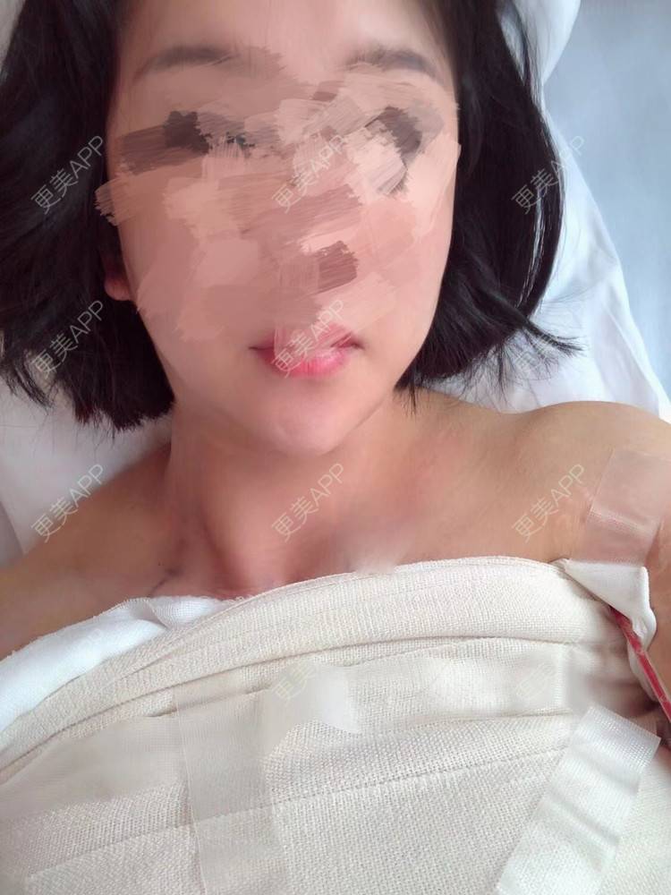 胸部下垂矫正手术_更美用户m1f06ovcym_术后115天__更美整形