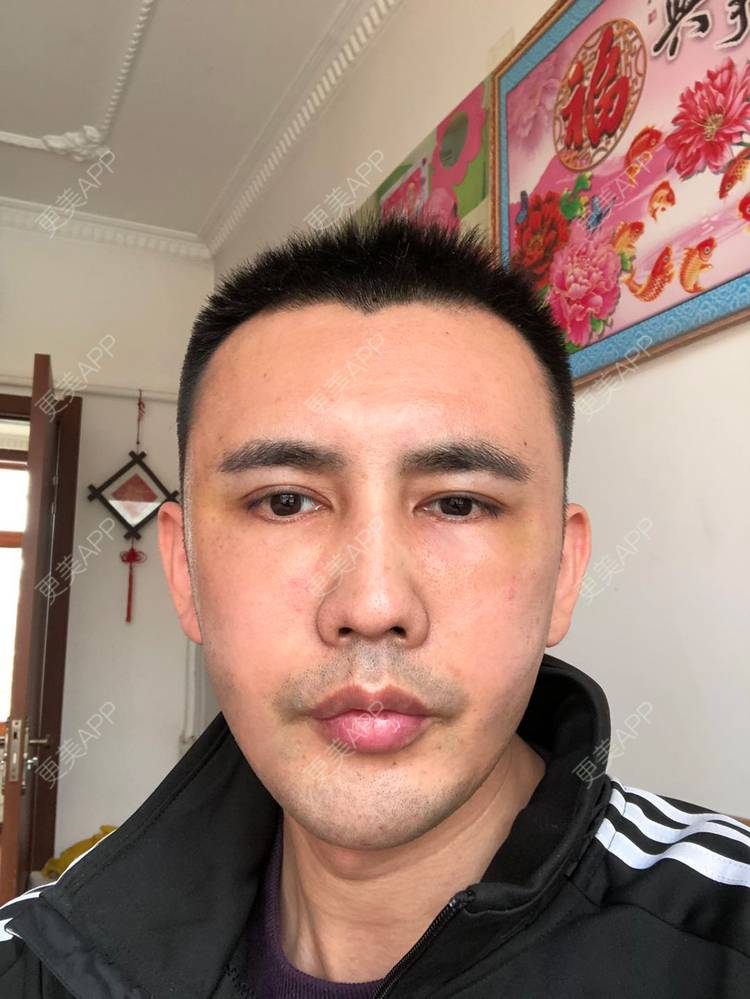 自体脂肪全面部填充 | 北京 | 自体脂肪丰额头 | 吸脂瘦大腿 | 维脂