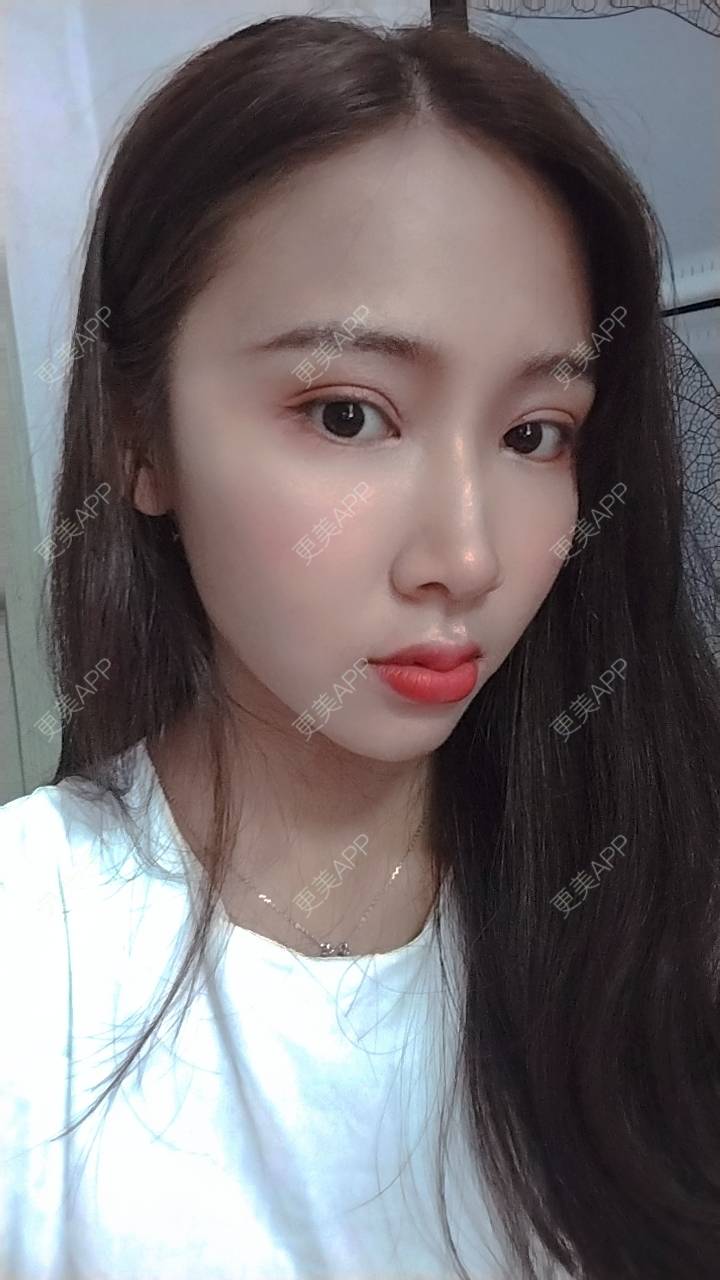 素人渔夫yy的全切双眼皮日记