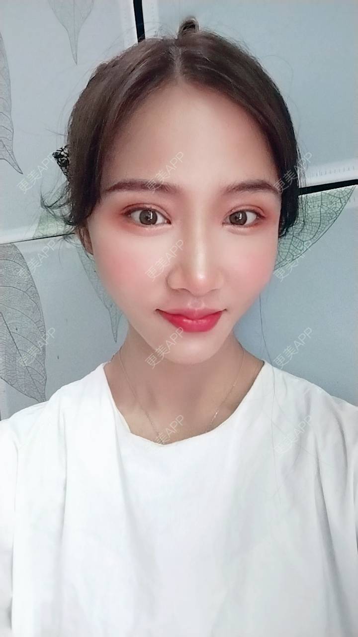 素人渔夫yy的全切双眼皮日记