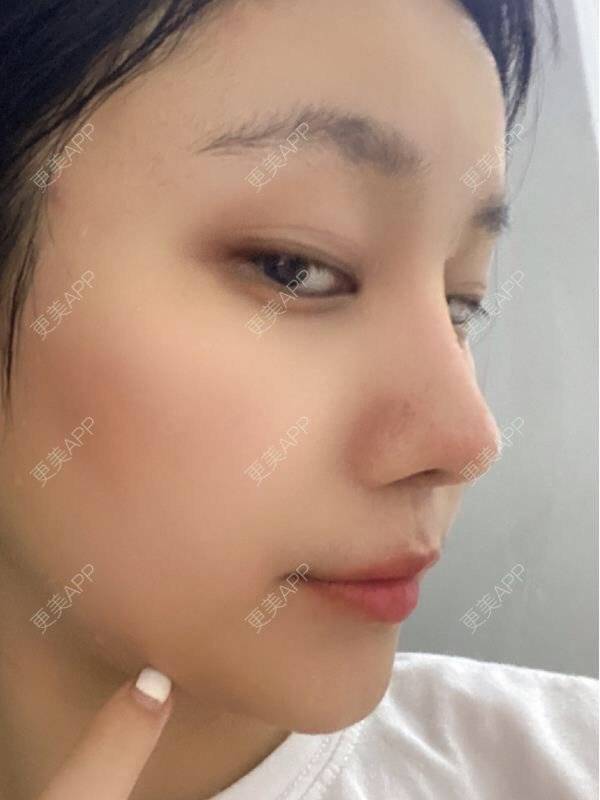 更美用户s8mvlzhldi的肋软骨隆鼻日记