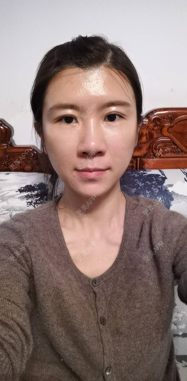 更美 - 凌木的夏云的额头日记 | 自体脂肪面部填充 | 自体脂肪全面部