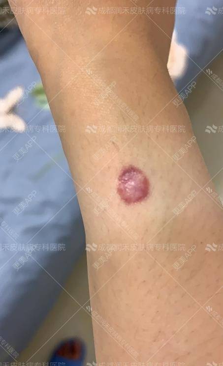 更美用户qsqoq4w6b0的激光淡疤日记