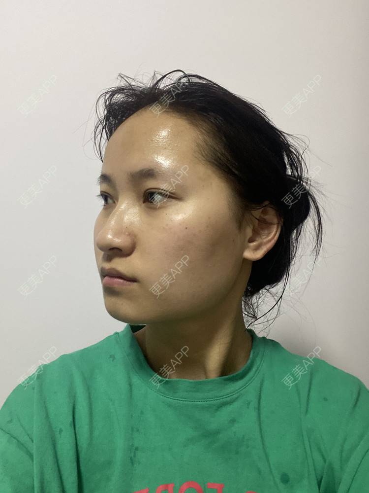 更美 - 熊小白ice的下颌角经验 | 下颌角 | 武汉