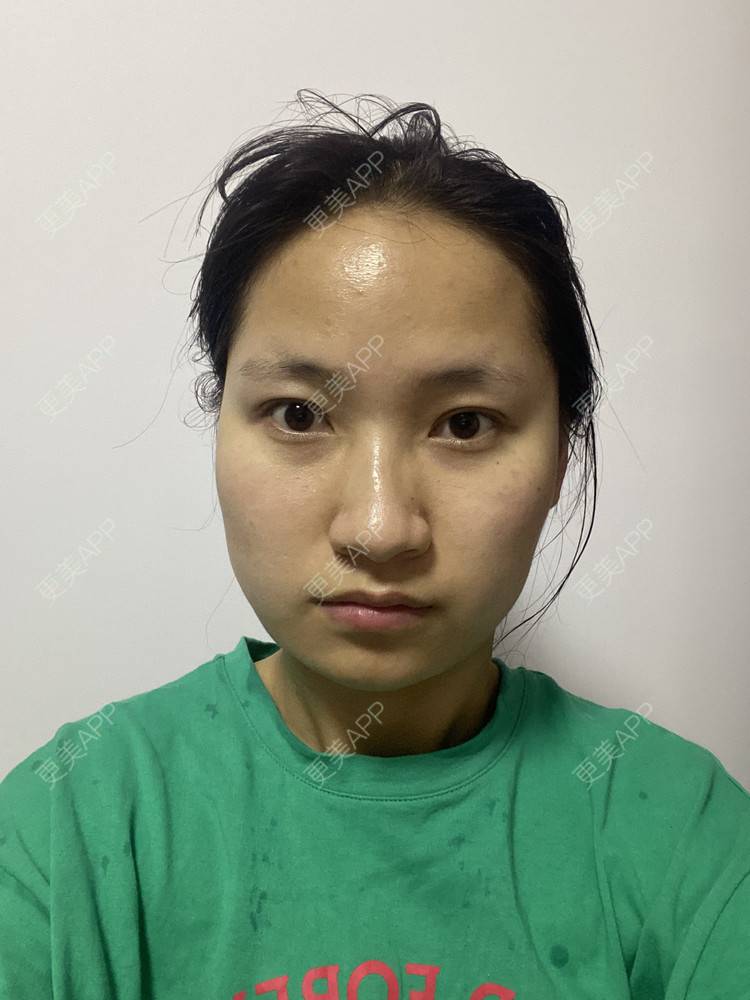 更美 - 熊小白ice的下颌角经验 | 下颌角 | 武汉