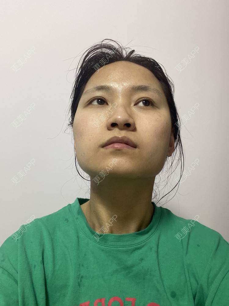 更美 - 熊小白ice的下颌角经验 | 下颌角 | 武汉