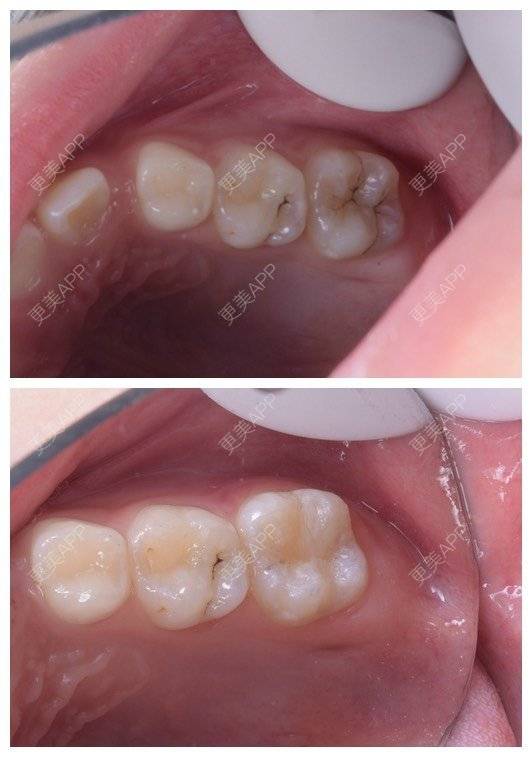 哎咿呀呀咿呀咿呀哟的树脂补牙日记