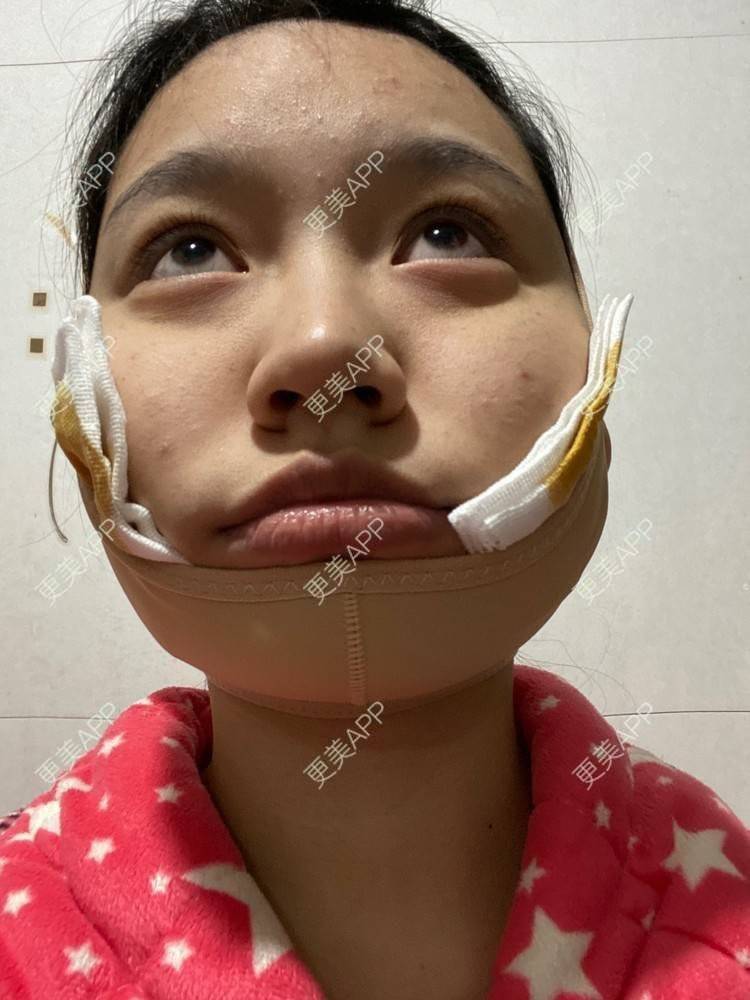 下颌角切除术手术_更美用户ghdaudgdkz_术后560天__更美整形