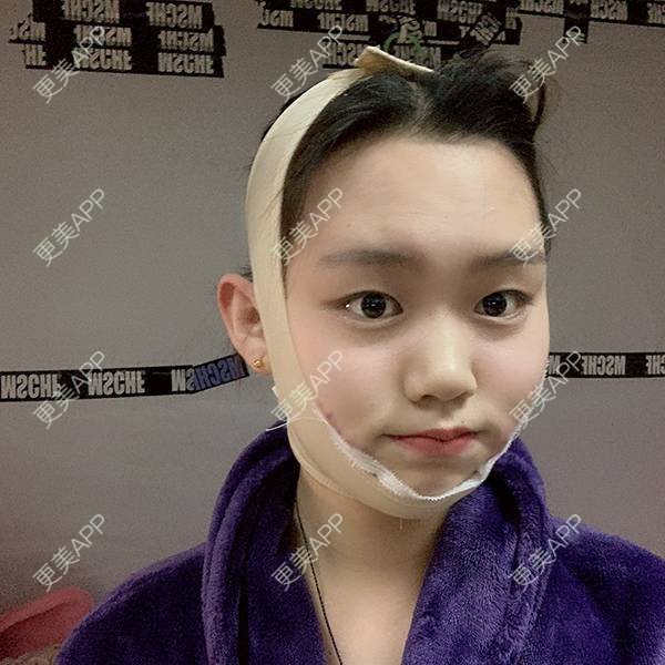 自说自话的小鹿彡的下颌角切除术日记