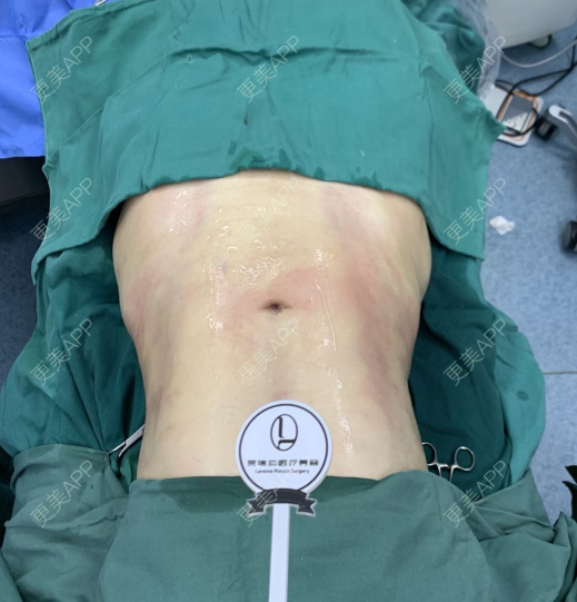 更美用户t0zppi0rhw的腰腹吸脂日记