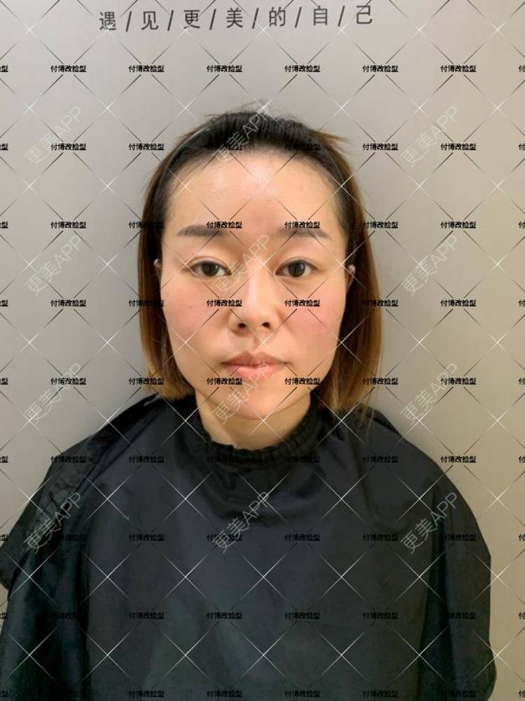 更美 - 逆风起舞的颧骨颧弓整形经验 | 颧骨颧弓整形 | 下颌角整形 | 武汉