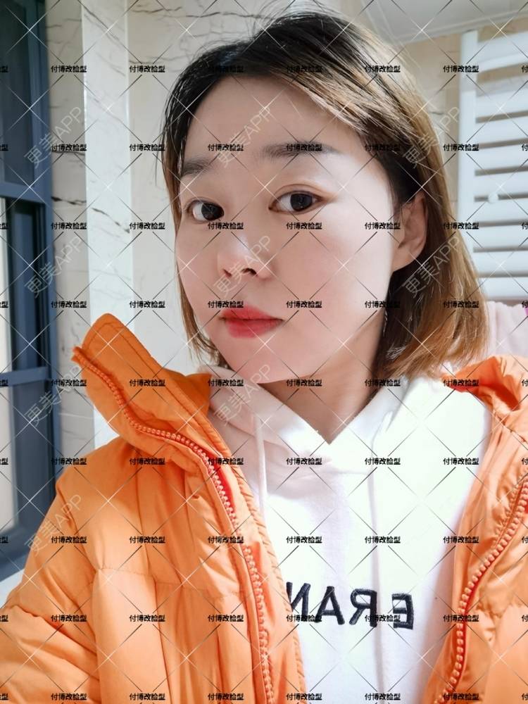 更美 - 逆风起舞的颧骨颧弓整形经验 | 颧骨颧弓整形 | 下颌角整形 | 武汉