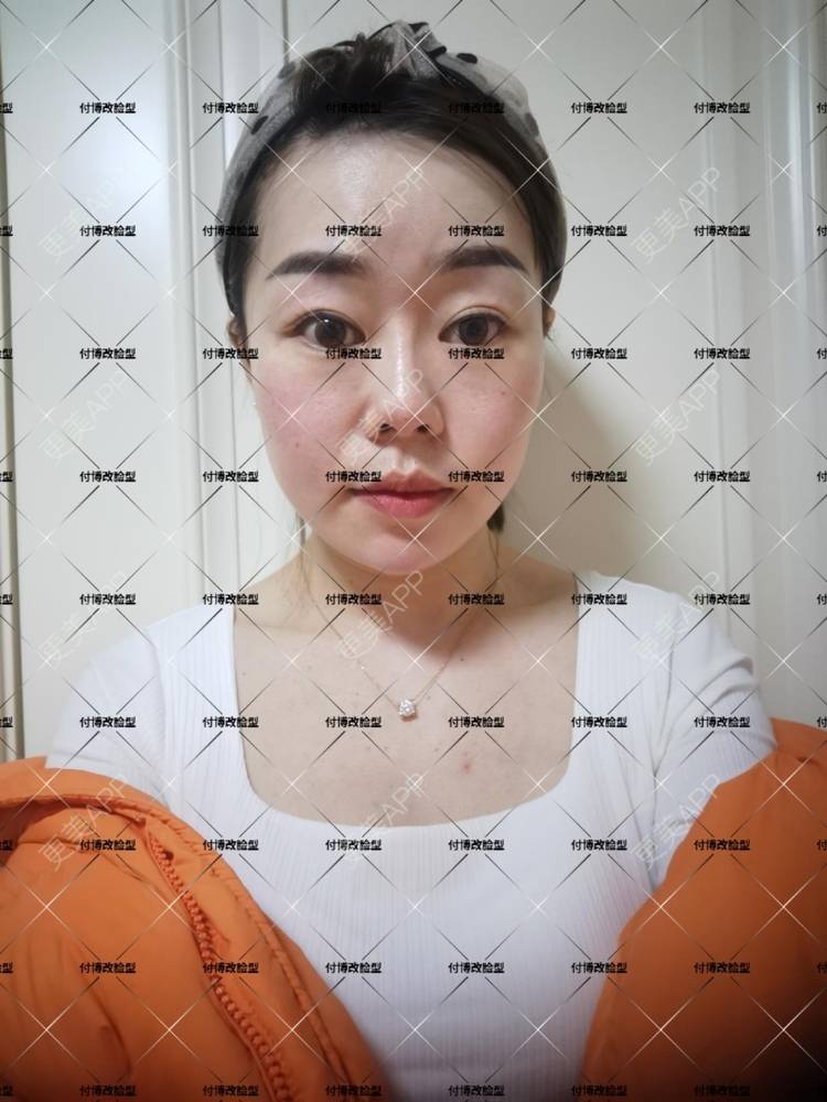 更美 - 逆风起舞的颧骨颧弓整形经验 | 颧骨颧弓整形 | 下颌角整形 | 武汉