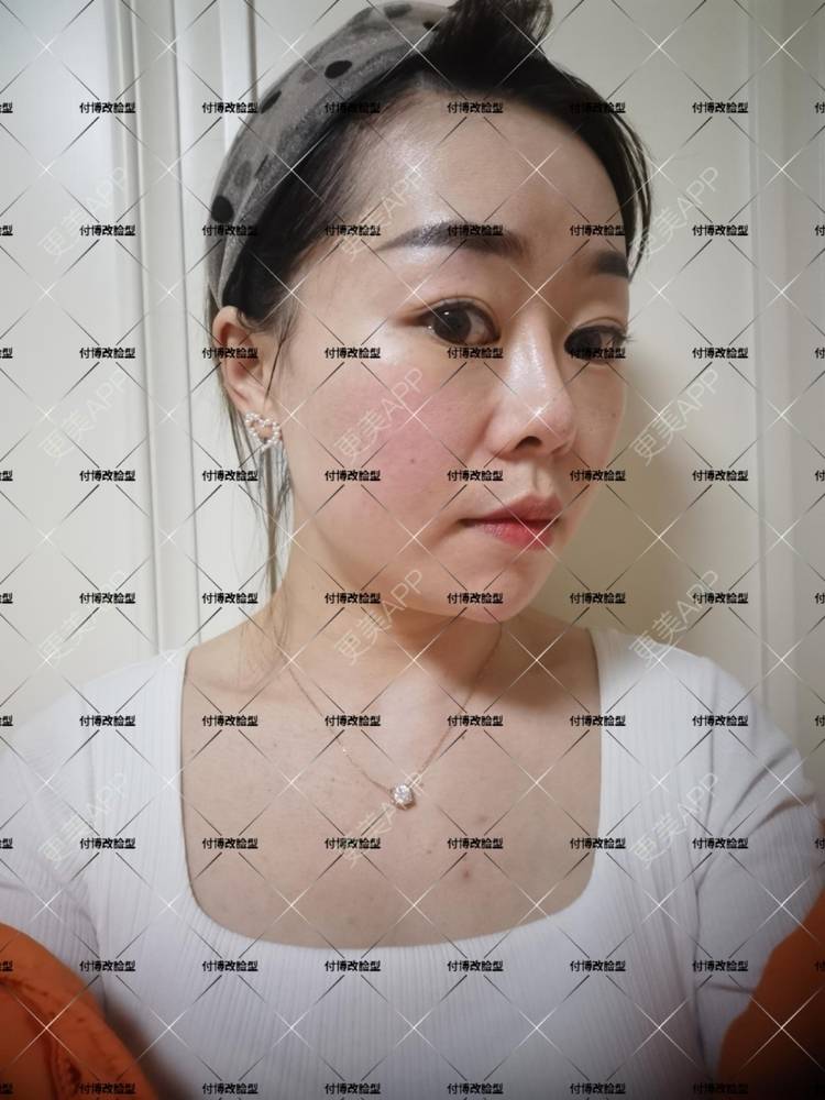 更美 - 逆风起舞的颧骨颧弓整形经验 | 颧骨颧弓整形 | 下颌角整形 | 武汉