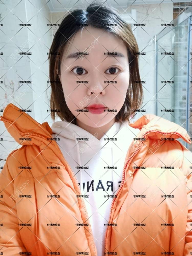 更美 - 逆风起舞的颧骨颧弓整形经验 | 颧骨颧弓整形 | 下颌角整形 | 武汉