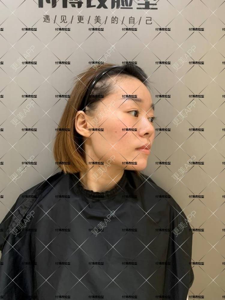 更美 - 逆风起舞的颧骨颧弓整形经验 | 颧骨颧弓整形 | 下颌角整形 | 武汉