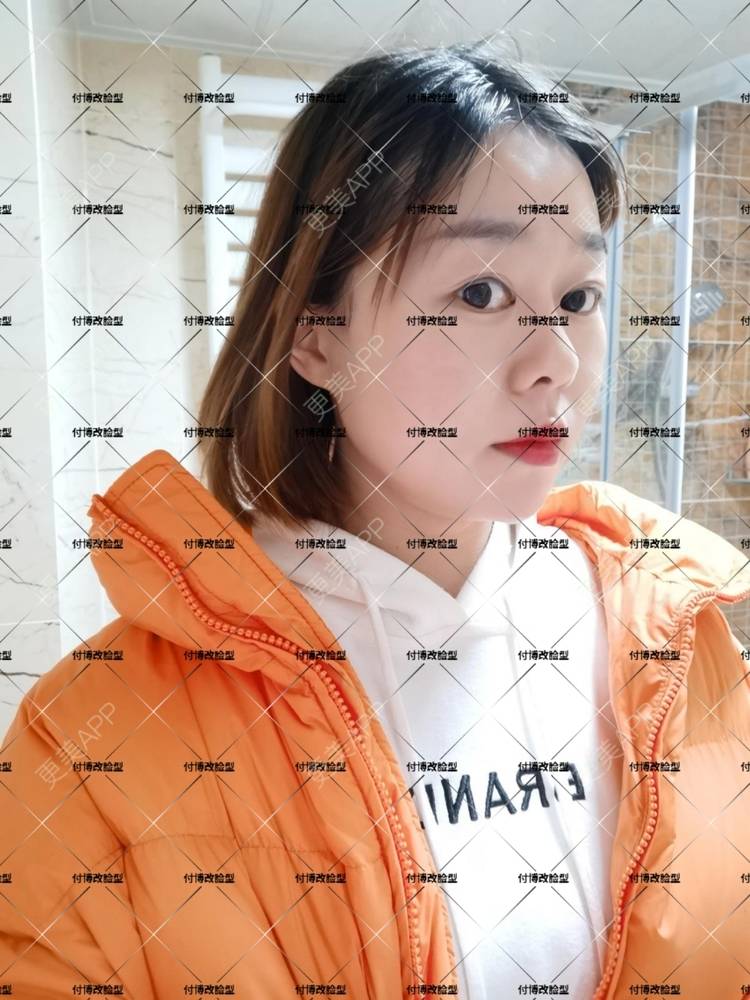 更美 - 逆风起舞的颧骨颧弓整形经验 | 颧骨颧弓整形 | 下颌角整形 | 武汉