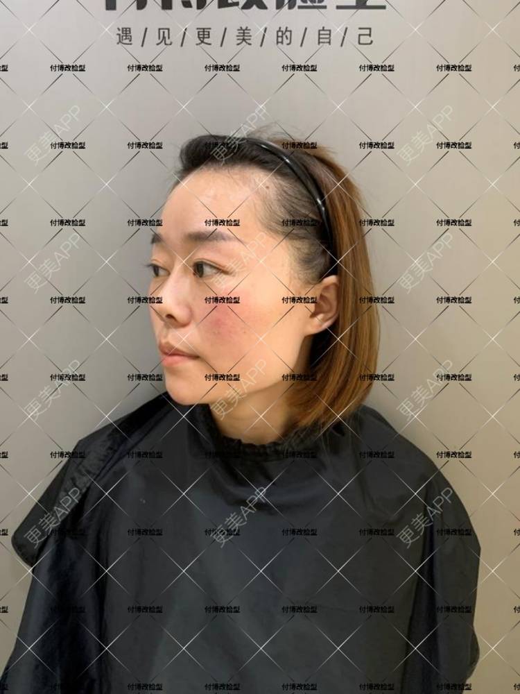 更美 - 逆风起舞的颧骨颧弓整形经验 | 颧骨颧弓整形 | 下颌角整形 | 武汉