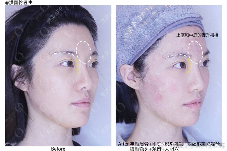 玻尿酸眉弓前后对比照_更美用户irjqo9vgpk玻尿酸眉弓前后对比照_术后