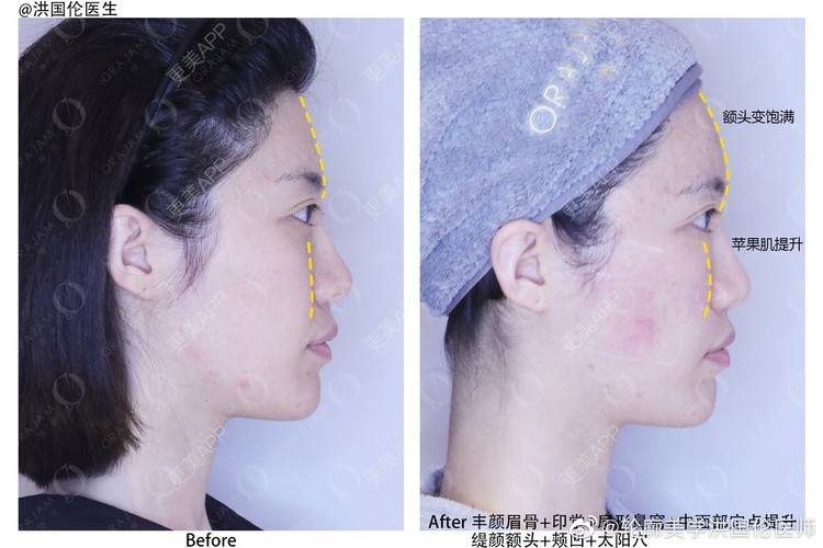 玻尿酸眉弓前后对比照_更美用户irjqo9vgpk玻尿酸眉弓前后对比照_术后