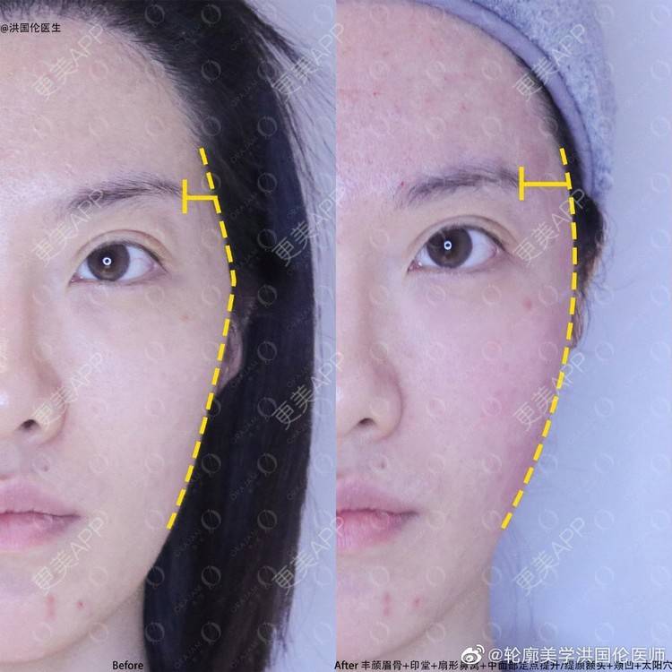 玻尿酸眉弓前后对比照_更美用户irjqo9vgpk玻尿酸眉弓前后对比照_术后